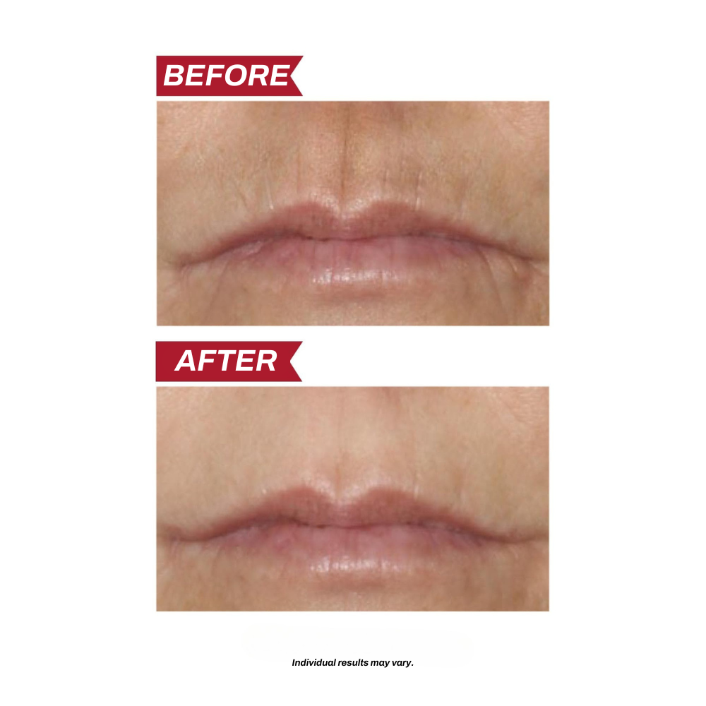 Pro Lip Contour Corrector – Age-Defying Perioral Care